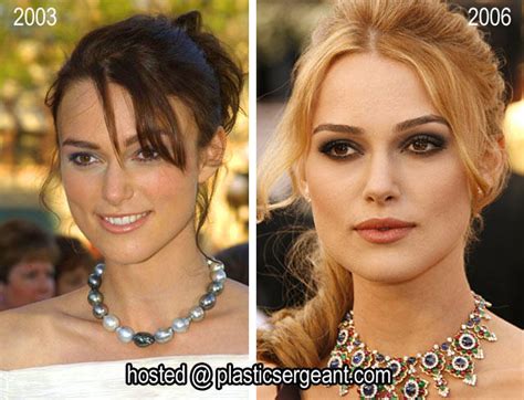 Keira Knightley Plastic Surgery Before And After Nose Job