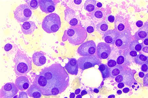 plasma cell myeloma hematomorphology  databank imagebank