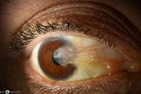 Pterygium Online Atlas Of Ophthalmology The University