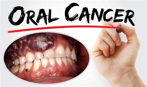 symptoms  oral cancer