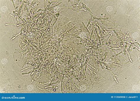 pseudohyphae  budding yeast cells  patient urine stock photo image  leucorrhea health