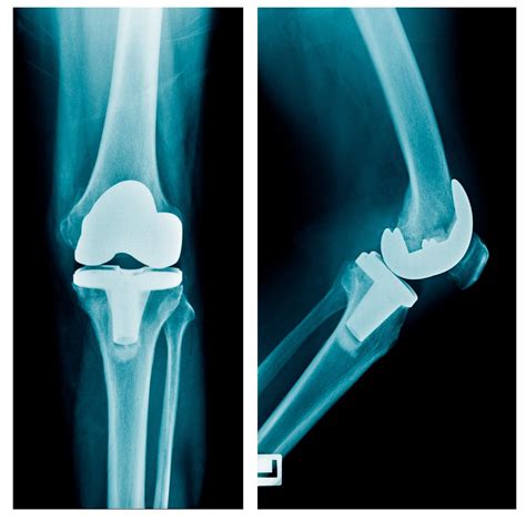 total knee replacement tkr dr  theodorides knee surgeon specialist