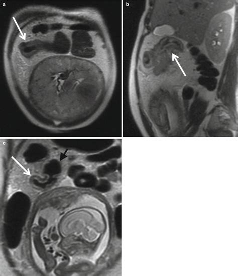 Mri Of Appendicitis And Bowel Diseases In Pregnancy Radiology Key