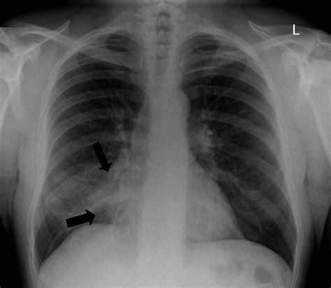 Lobar Collapse Demystified The Chest Radiograph With Ct Correlation