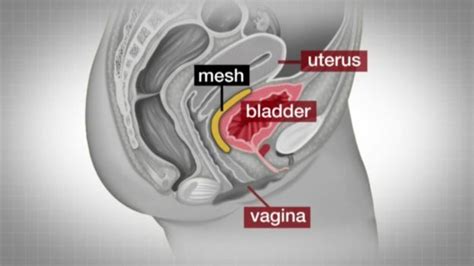 Women Deserve Apology Over Vaginal Mesh Implants Bbc News