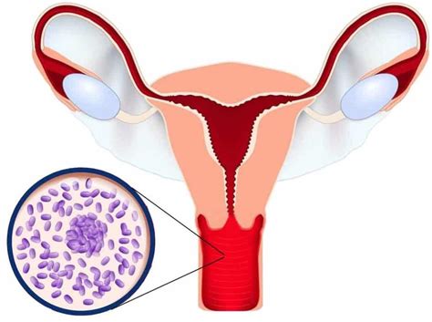 bacterial vaginosis bv symptoms causes and treatment