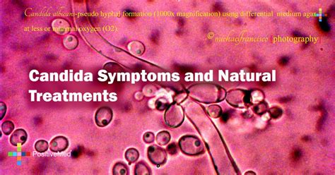Candida Symptoms And Natural Treatments 1 Positivemed