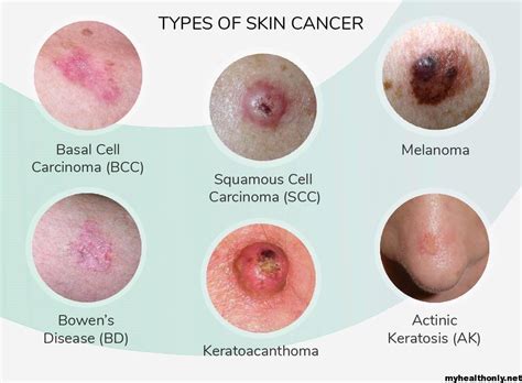 symptoms  skin cancer risk factors signs   health
