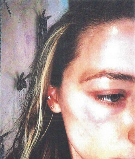 Amber Heard Seen Leaving Courthouse With Black Eye