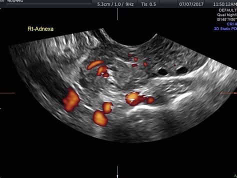 diagnosing ovarian torsion  ultrasound empowered womens health