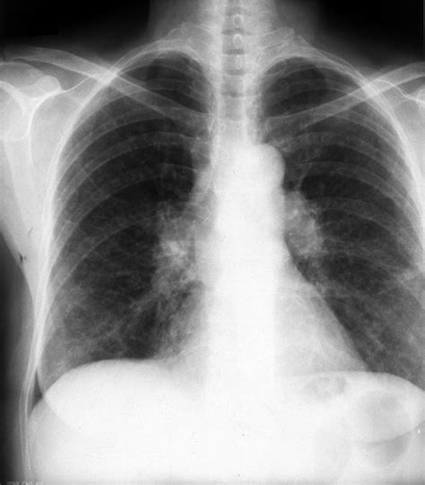 Asymptomatic Stage I Sarcoidosis Complicated By Pulmonary Tuberculosis