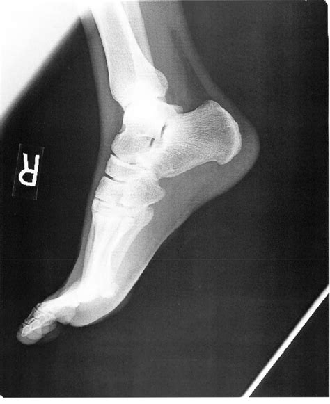 Foot Right X Ray 002 No Info Scan Of My Foot From The