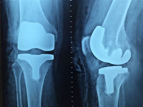 conservative treatment of a femur fracture a case report