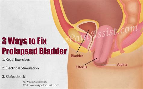 3 Ways To Fix Prolapsed Bladder Bladder Exercises