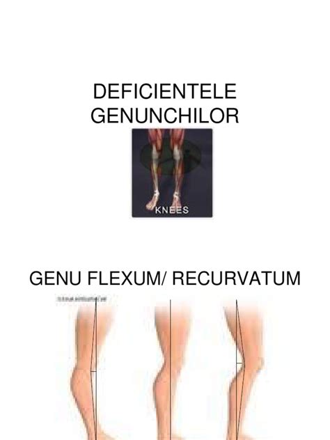genu flexum