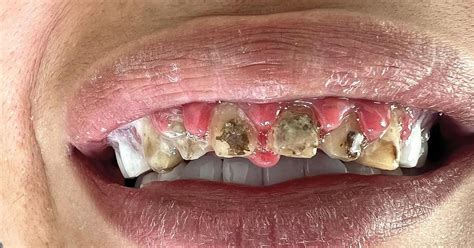 patients    agony  botched teeth work  turkey