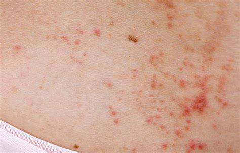 heat rash  adults  treatment  prevention tips