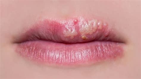 genital herpes can you get it during oral sex with someone who gets