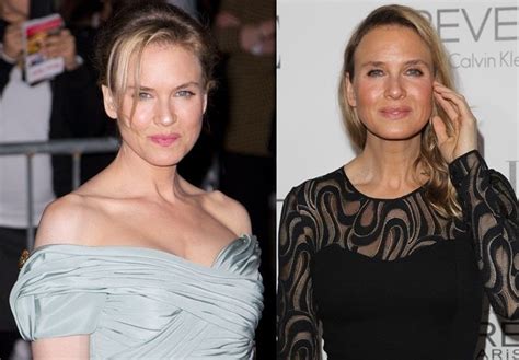 renee zellweger s face before and after plastic surgery