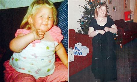 Morbidly Obese Woman With Prader Willi Syndrome Ate Herself To Death