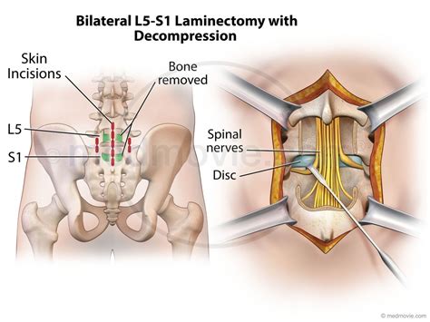 medmoviecom bilateral   laminectomy  decompression