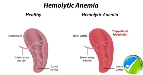 pin on hemolytic anemia