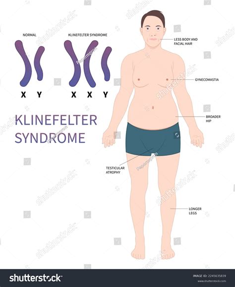 Klinefelter Syndrome All You Need To Know – Sdlgbtn 56 Off