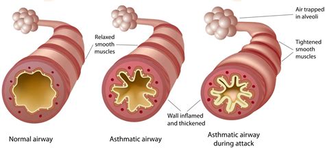 complete guide  asthma  children  aid