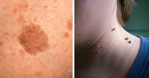 here s how to naturally resolve skin tags warts