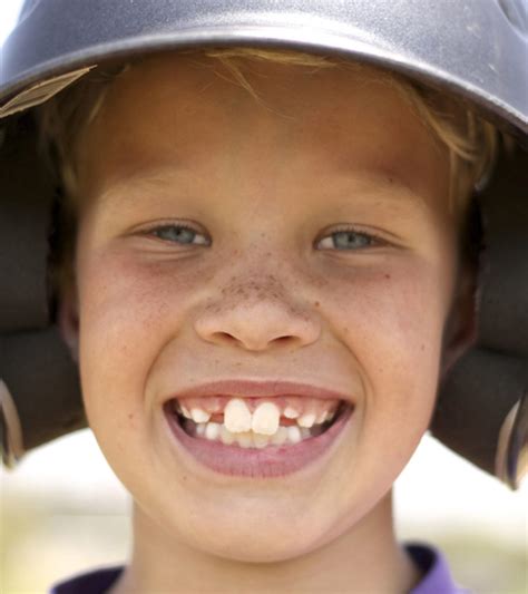 buck teeth  kids  health risks pictures