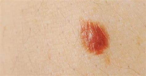 what causes skin moles ~ how to remove moles warts skin