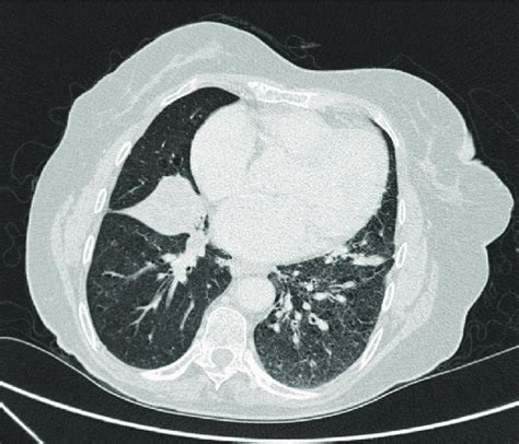 Ct Thorax Scan Showing A Right Middle Lobe Collapse Download