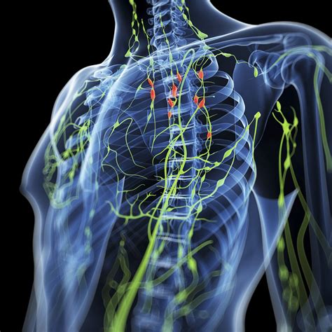 nodular sclerosing hodgkin lymphoma  overview