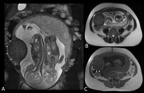 Imaging Of Acute Abdominal Pain In The Third Trimester Of Pregnancy
