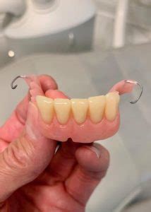 partial dentures beforeafter dr gentry