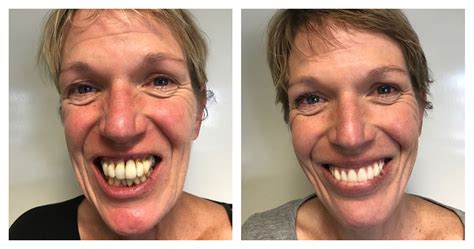 Dental Implant Before And Afters Archives Ace Dental London W1