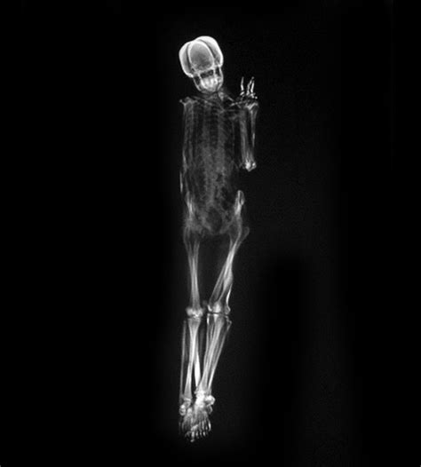 x ray photos of couples