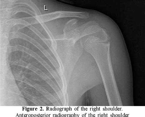 Figure 2 From Proximal Humeral Physeal Widening Little