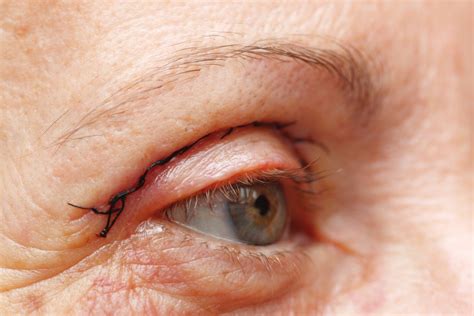 ooglidcorrectie centrum voor plastische chirurgie komt naar utrecht foto adnl