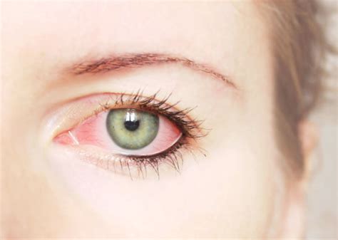 types  pink eye  healthy