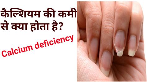 calcium deficiency symptoms  hindi  driansari  channel youtube