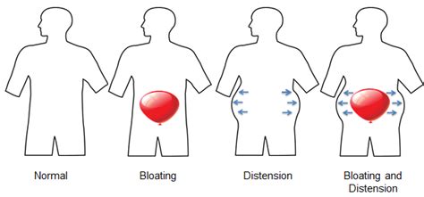 Abdominal Bloating Versus Distension A Blog By Monash Fodmap The