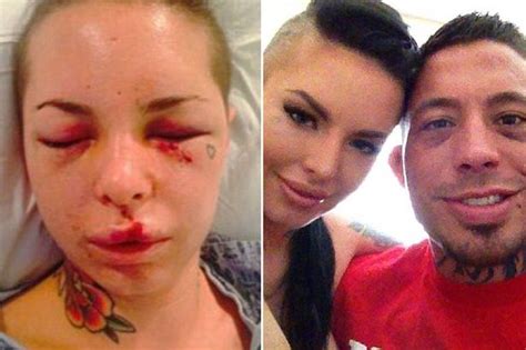 shocking pictures show porn star s horrific injuries at