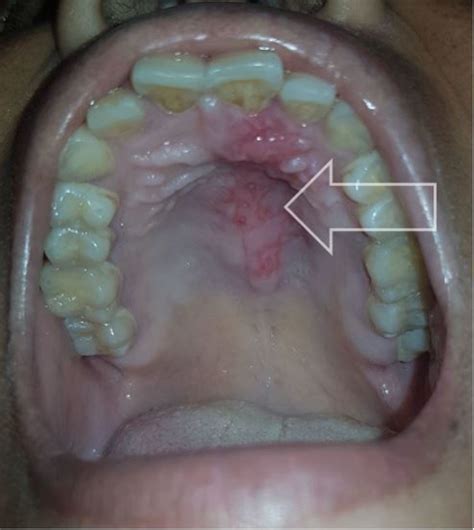 mouth pain  cheek numbness emergency medicine journal