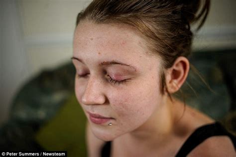 Schoolgirl 16 Almost Blinded After Suffering Allergic Reaction To