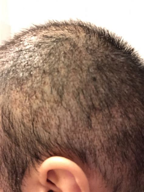 hair transplant shock loss  donor area hairsxl