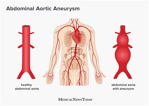 aortic aneurysm symptoms nhs