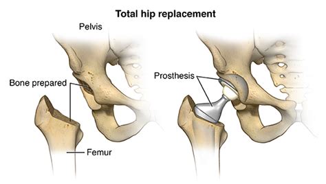 Hip Replacement Surgery Health Encyclopedia University