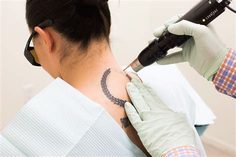10 Things No One Tells You About Tattoo Removal Glamour