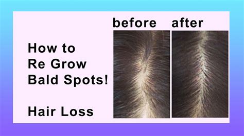 hair loss natural home remedy youtube